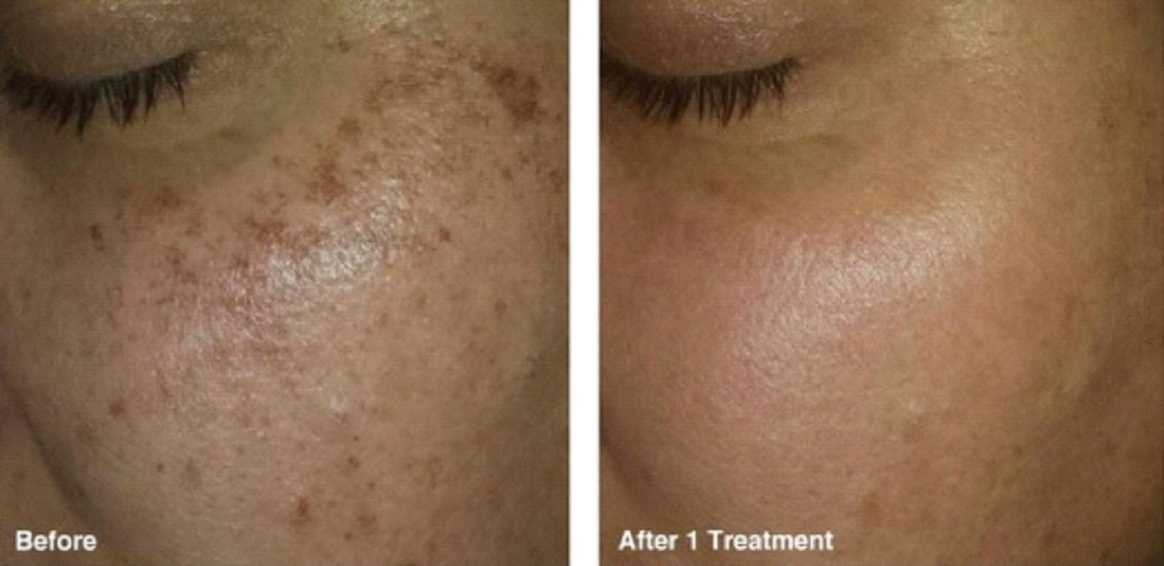 Skin Pigmentation 