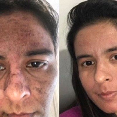 Stemcells NON-Chemical Peel Treatment