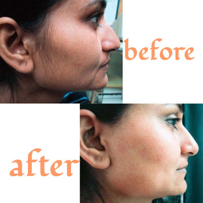 Laser Hair Reduction Treatment