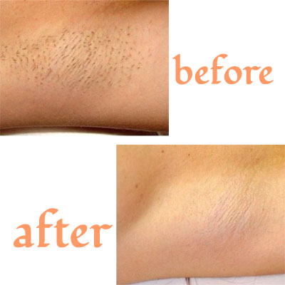 Laser Hair Reduction Treatment