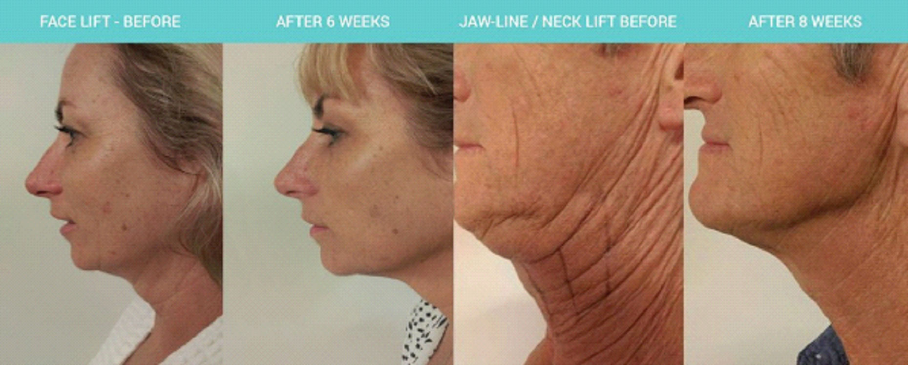 Skin Tightening Treatment