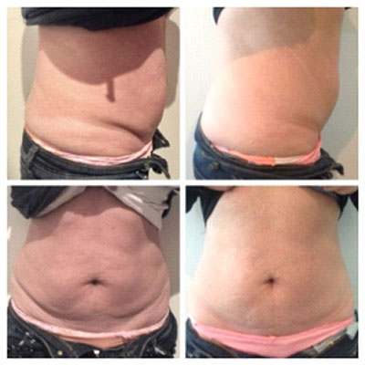 Skin Tightening Treatment