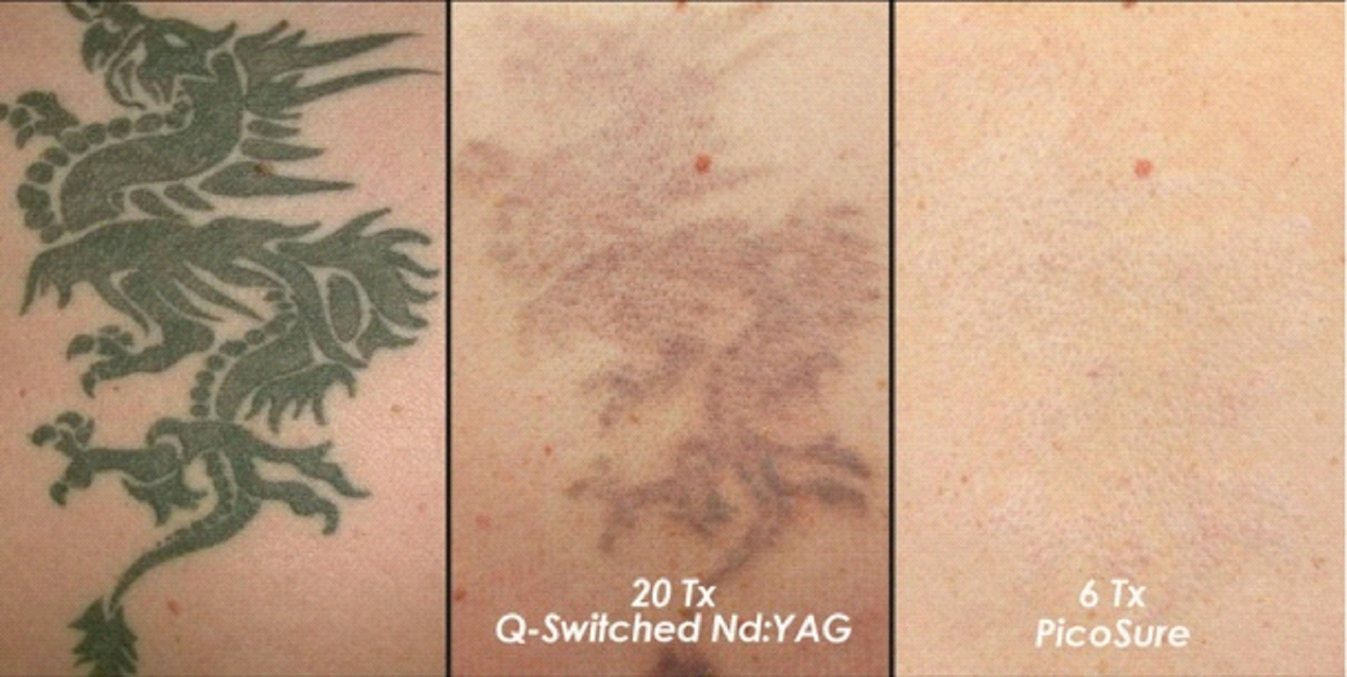 Tattoo Removal Treatment