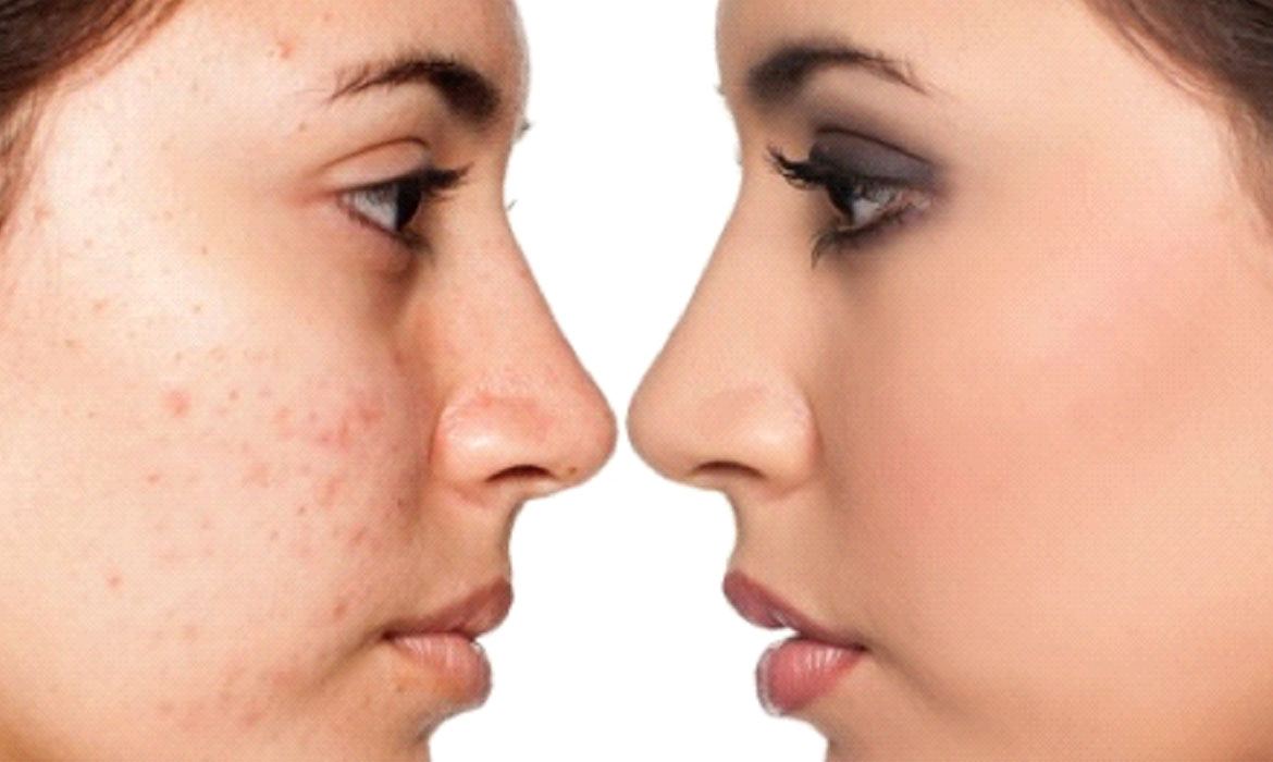 Acne, Scar Treatment