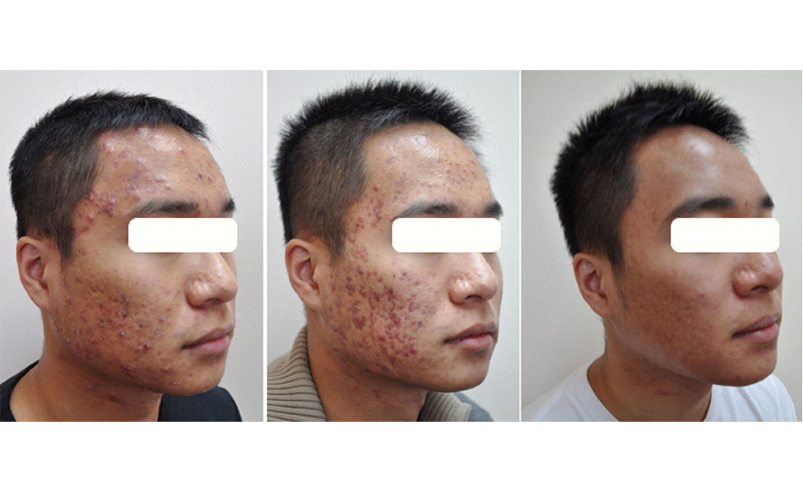 Acne, Scar Treatment