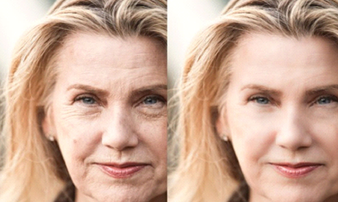Botox Treatment