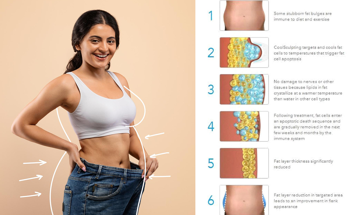 Fatloss Treatment