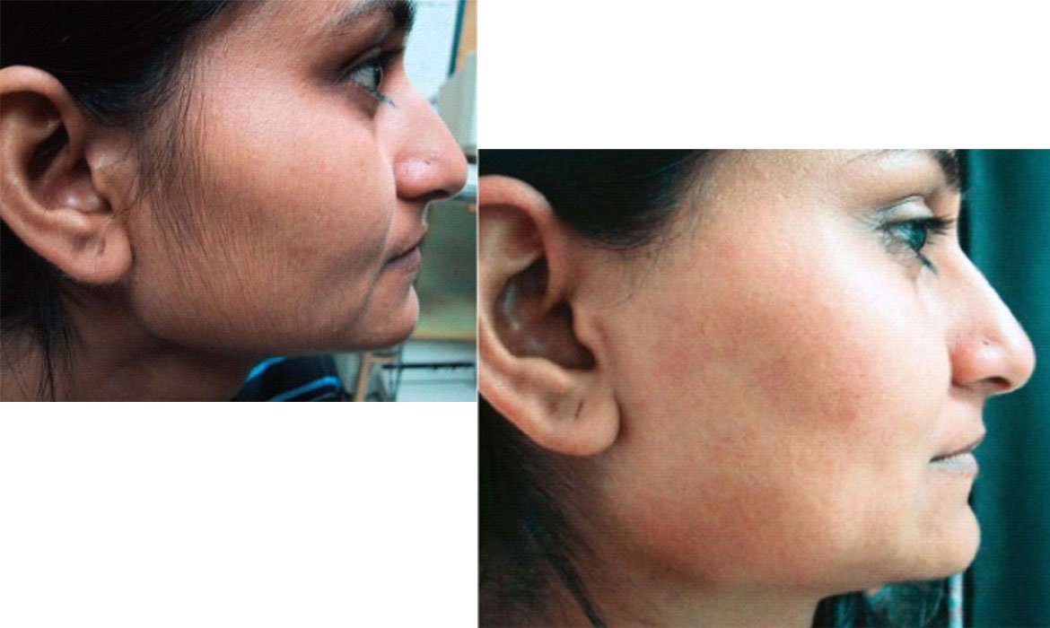 Hair Reduction Treatment
