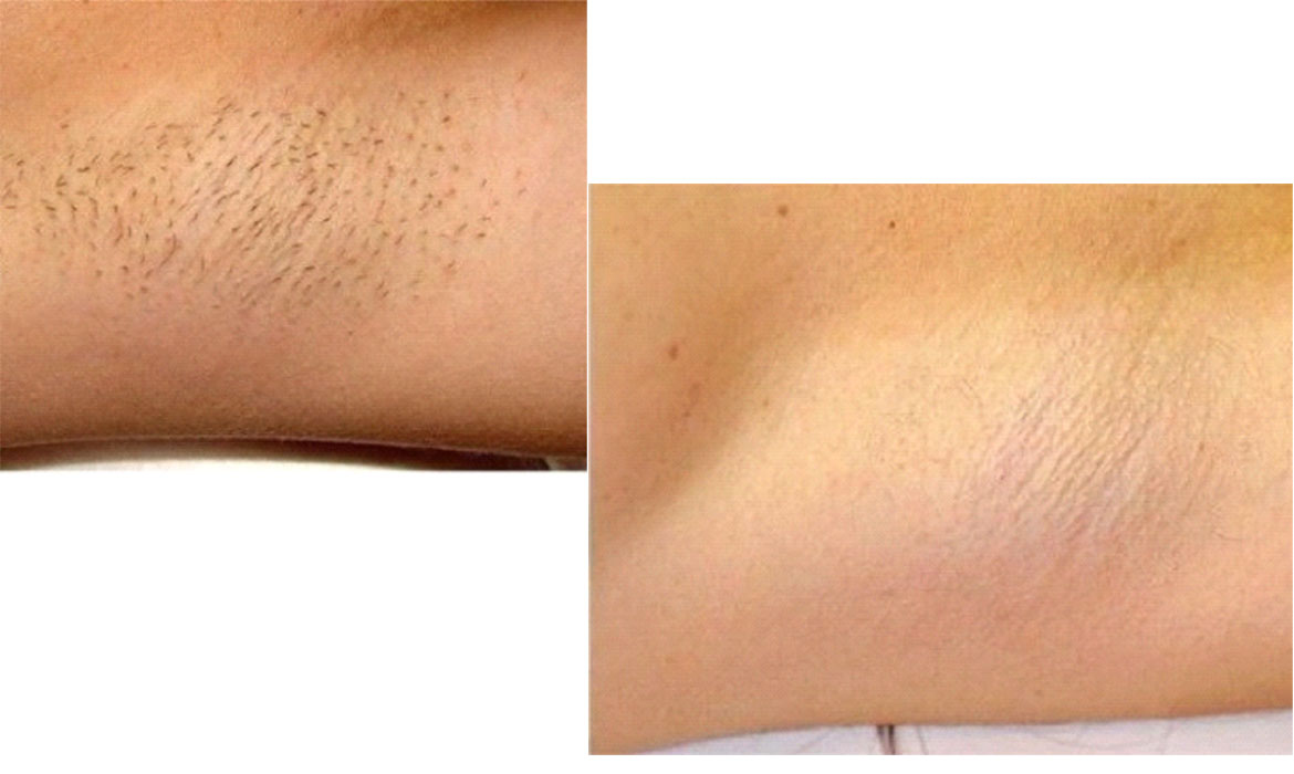 Hair Reduction Treatment