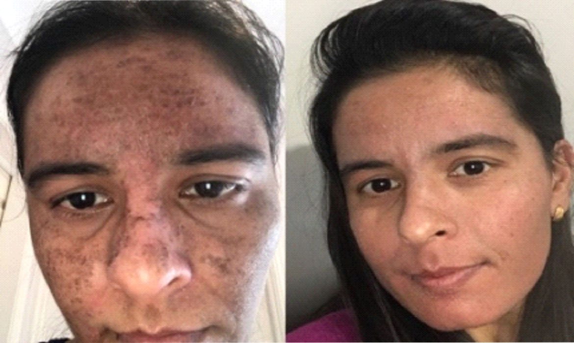 NON-Chemical Peel Treatment