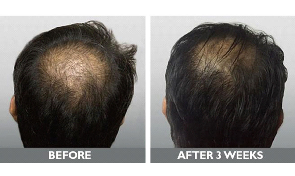 PRP Treatment