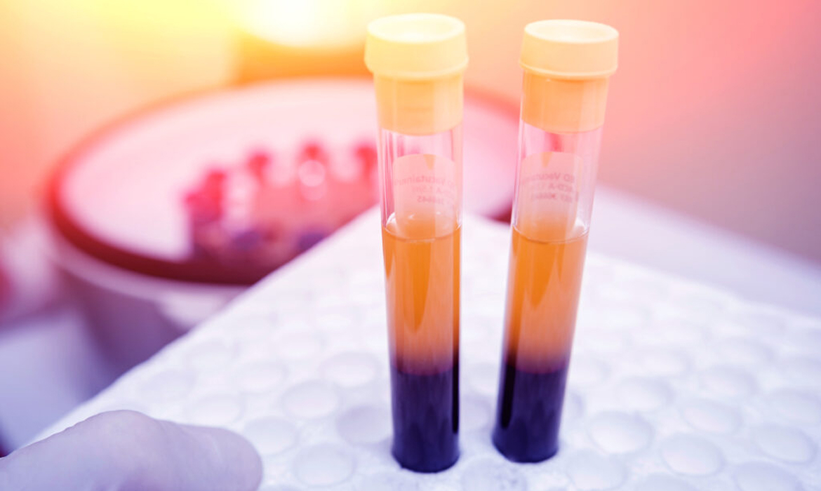 Stemcells Prp Treatment