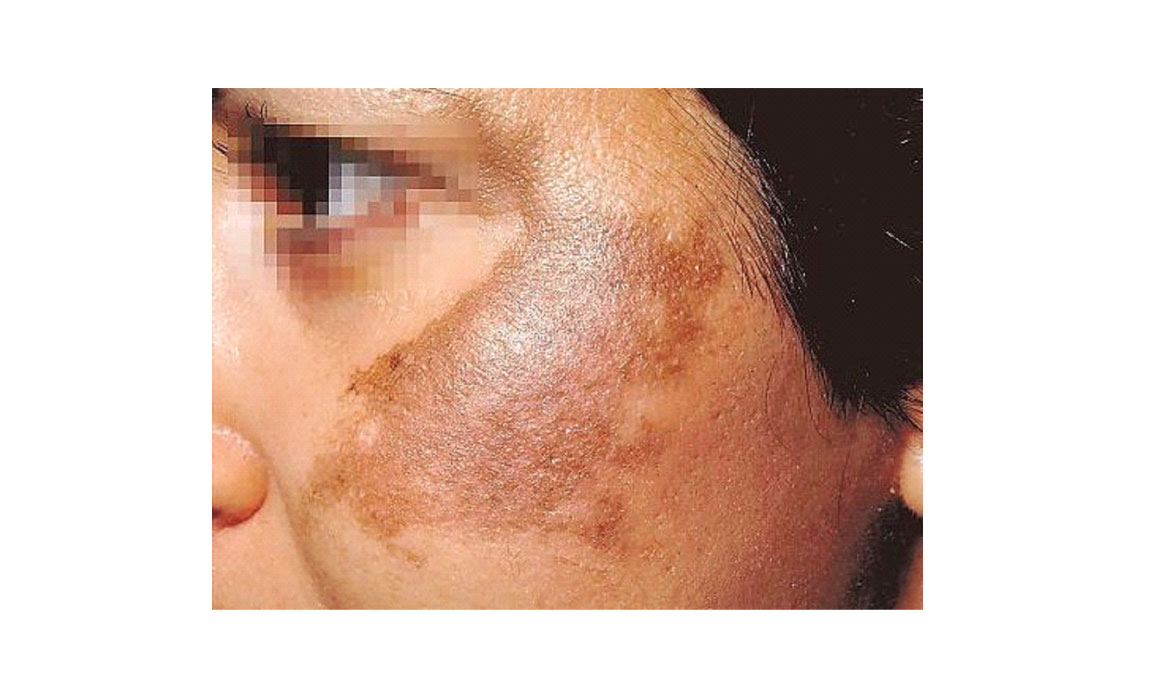 Pigmentation Treatment