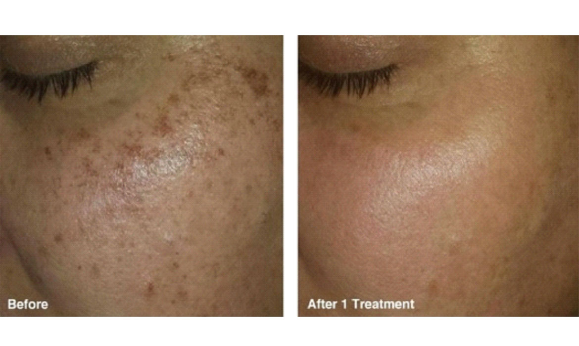 Pigmentation Treatment