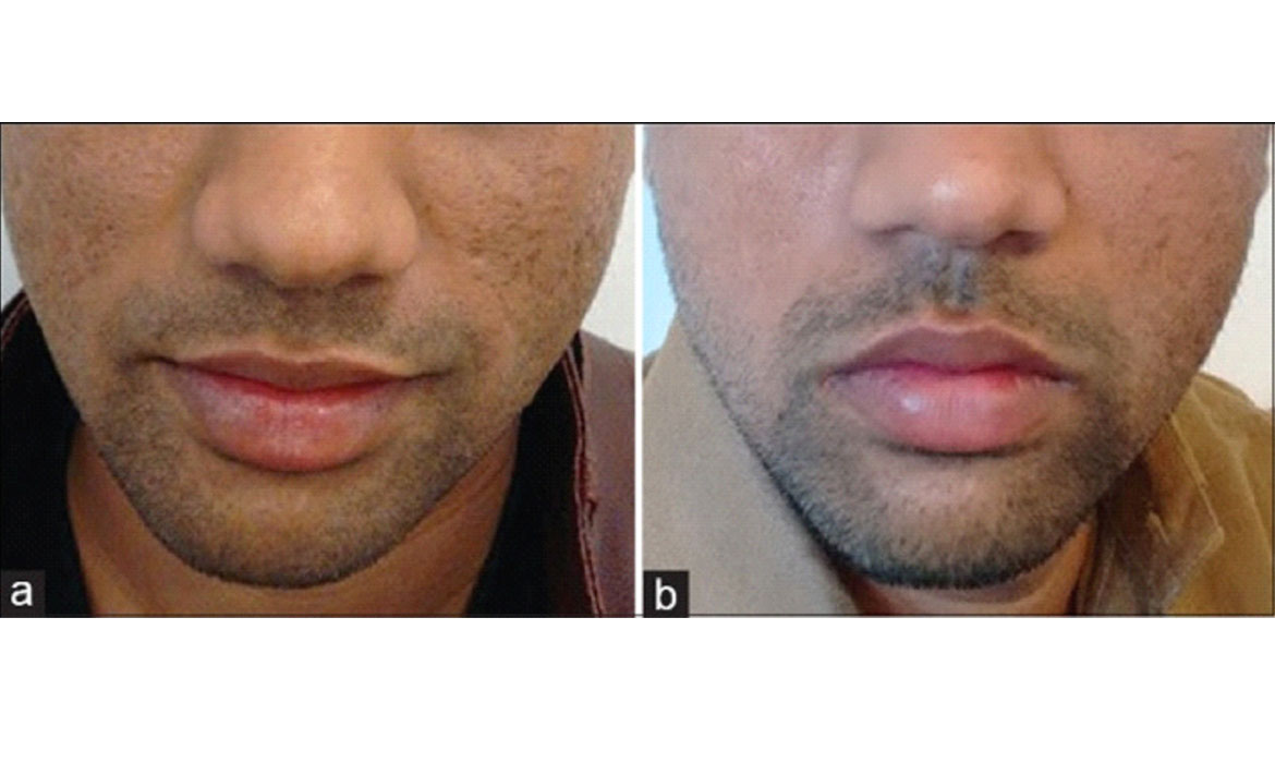 PRP Treatment