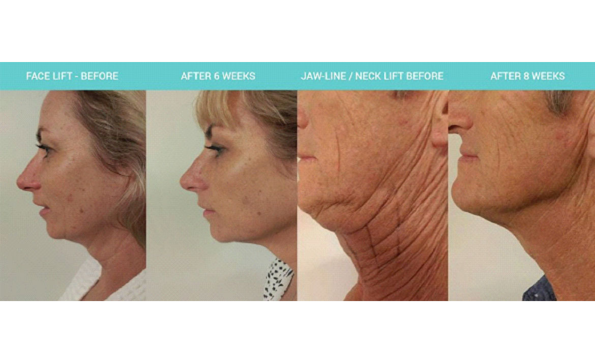 Skin Tightening Treatment
