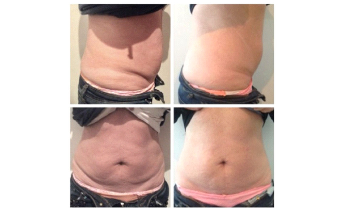 Hair Reduction Treatment