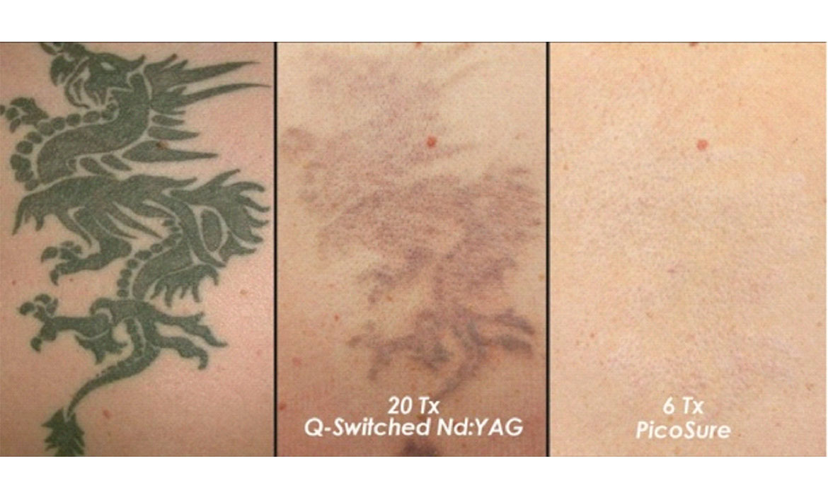 Tattoo Removal Treatment