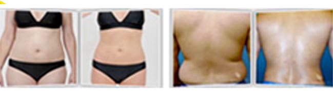 Lipo Suction weightloss Treatment